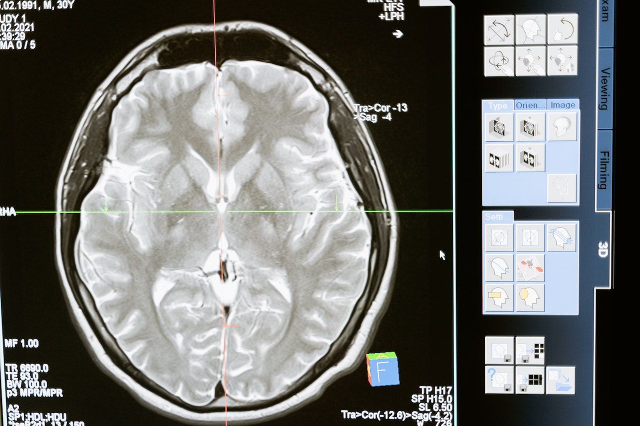 Aphasia – What it is and How Speech Therapy Can Help